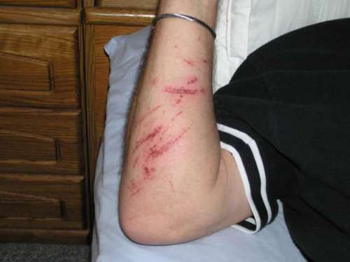 Ouch--but you should see the other guy--well, the tree was the other guy
