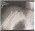 Stone broken humerus (upper arm)_2012.jpg